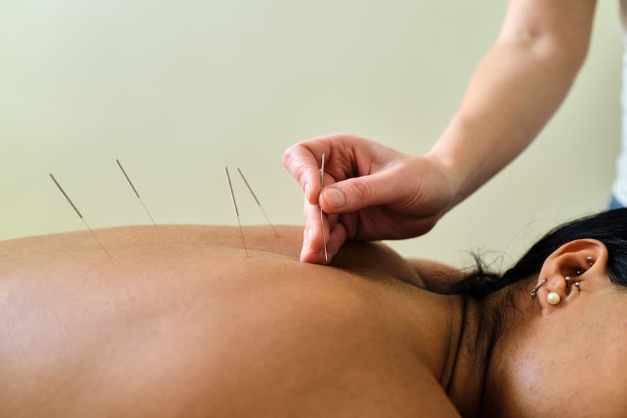 mulher deitada recebe acupuntura nas costas
